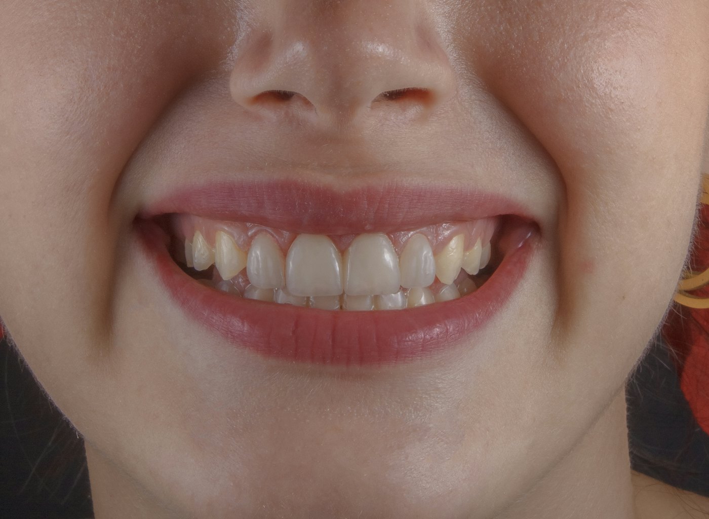 Sonrisa de una paciente después del blanqueamiento